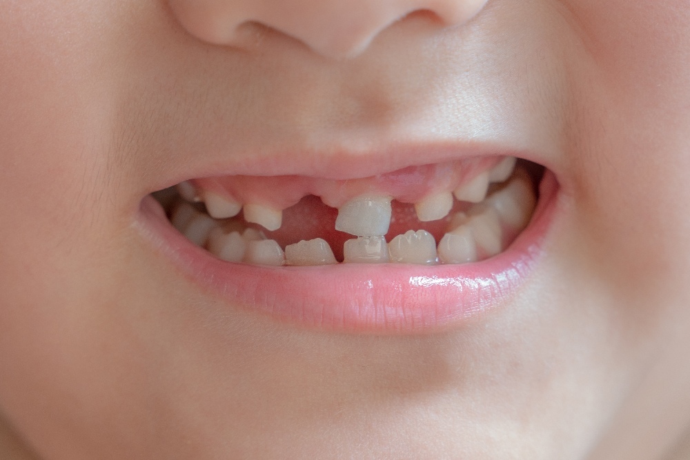 Teeth Injury in Children: What can be done to treat this condition?