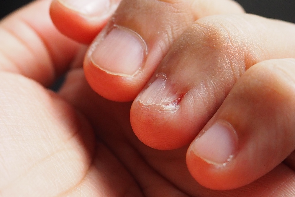 What might be the reason why my fingernail is turning blue? - Quora